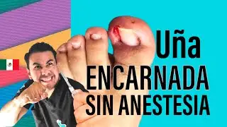 Cómo sacar una #uñaencarnada infectada, sin anestesia y #sindolor