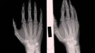Osteopoikilosis