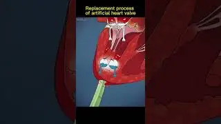 Artificial heart valve