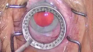 Cataract Surgery: Super Phaco Pearls Volume 1