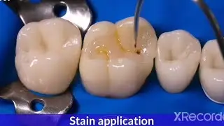 Class I Composite Restoration بالشرح العربي البسيط