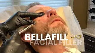 Bellafill Facial Filler | Infinity MedSpa
