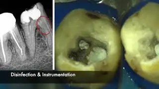Instrument Retrieval Tips & Technique =on Mandibular 1st  Molar