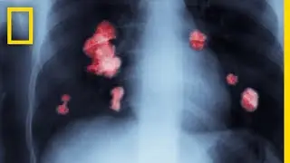 Cancer 101 | National Geographic