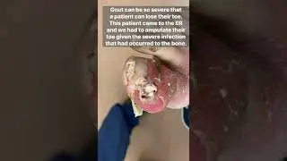 GOUT SO SEVERE IT DESTROYED BIG TOE!😱UNREAL! 