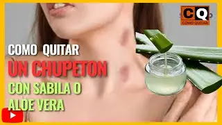 COmo quitar un chupetón con sábila | Rápido y NATURAL | Aloe Vera para chupetones