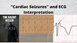 Cardiac seizures (HOCM, ARVC, Brugada Syndrome, Long QT syndrome/polymorphic VT)
