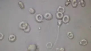 КРОВЬ И СПЕРМАТОЗОИДЫ в МОЧЕ под микроскопом!!! BLOOD And SPERMATOZOA in URINE under a microscope!!!
