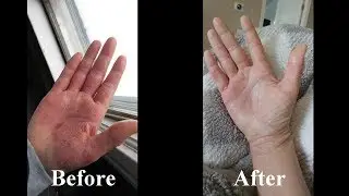 Pros and Cons of Gut Testing for Eczema
