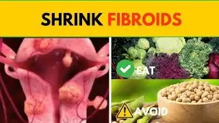 Shrink Fibroids: 10 Best and Worst Foods For Fibroids