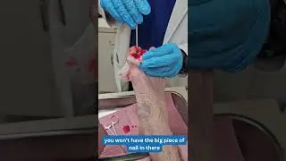 Transformative Treatment for Massive Ingrown Toenail by Top Podiatrist Dr. Kevin Lam | #footandankle
