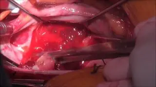 Left Atrial Myxoma