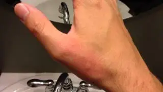 Hives from food allergy