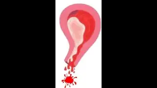 Fibrinogen Concentrate use in ICU_Overview