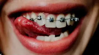 How to kiss with braces.