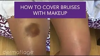 How to Cover Bruises With Makeup (it's easy!)