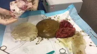 Opening up 30 year old breast implants! Disturbing fluid inside! - Orange County Plastic Surgery