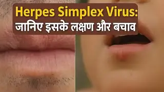 Herpes Simplex Virus: जानिए इसके लक्षण और बचाव #HerpesSimplexVirus #HSV  #MedicalEducation