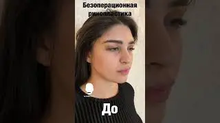 Сделали нос без операции.
