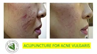 ACNE VULGARIS: A Quick and Comprehensive Approach