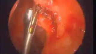 Eustachian Tube Surgery