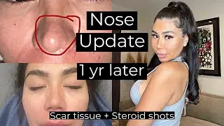 One Year Rhinoplasty UPDATE *the TRUTH ABOUT NOSE JOBS!