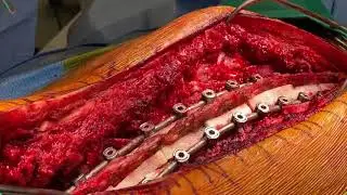 Spinal Fusion from T4-Pelvis