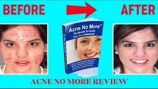 Acne No More Review - The Only Solution You Need