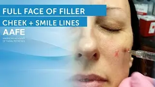 Adding Mid and Lower Face Volume with Fillers