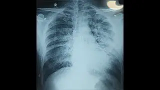Rescue Primary PCI