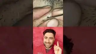 Look what they PULL OUT of these PORES in the skin