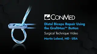 Dr. Martin Leland - Distal Biceps Repair Using the GraftMax™ Button - CONMED Surgical Technique