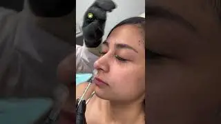 Botox Nose Lift
