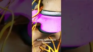 Lumbar Spondylolysis Symptoms