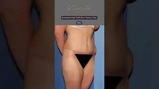 Extended High Definition Tummy Tuck 🤩