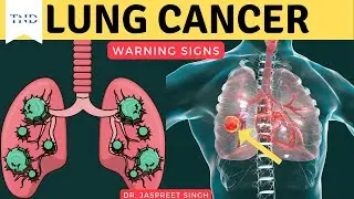 Lung cancer warning signs don't ignore these!