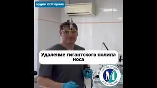 Удаление полипа носа лазером и шейвером.