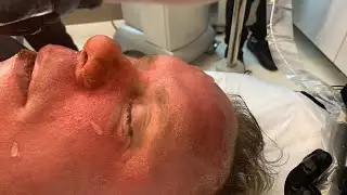 Laser Recovery Treatment w/Microneedling & PRP | Facial Rejuvenation/Resurfacing Part 4 | Dr. Emer