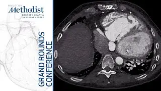 Mechanical Support in ACHD Patients (Peter Ermis, MD and Edward Hickey, MD) November 5, 2020