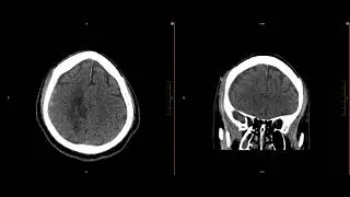 Neuroradiology Call Prep Cases: Acute Subdural Hematoma (CT) Case 9 Discussion