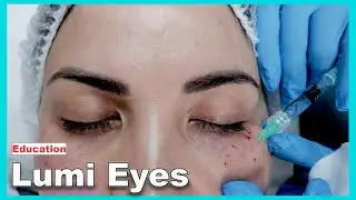 Lumi Eyes injection technique points and before and after photos