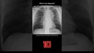 Chest X-ray Quiz 15 (explanation with overlays)