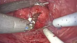 #208 Robot Assisted Simple Prostatectomy with Hugo RAS system Dr. Adele Piro