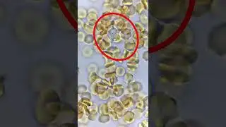 White blood cell attacks a yeast cell!