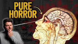 The Lobotomy Was SO Much Worse Than You Think