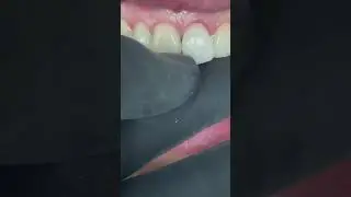 For thin veneer