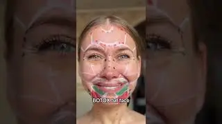 full face botox #botoxinjection #botox #facebotox #wrinkebotox