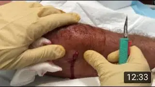 arm infection and sepsis