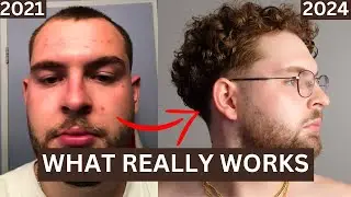 How I Cleared Up My Skin | How To Achieve Clear Skin Men | Mens Skin Care Tips