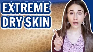 SIGNS OF EXTREME DRY SKIN // ICHTHYOSIS VULGARIS 